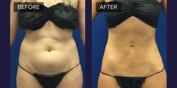 Cavi-Lipo ultrasound and laser treatments for safe fat loss