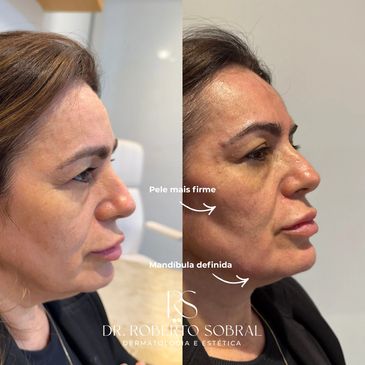  O bioestimulador atua estimulando a produção natural de colágeno.