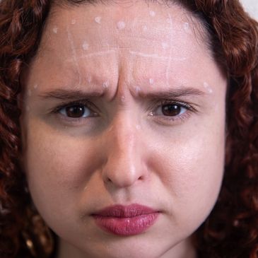  Procedimento indicado para suavizar linhas de expressão e prevenir o envelhecimento da pele.