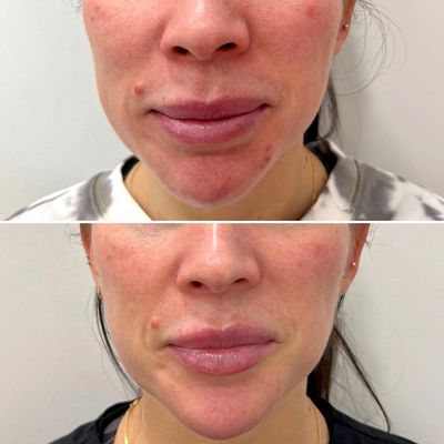 Masseter Botox in Stockport and cheshire