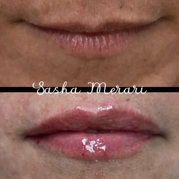 Lips, Filler, spa, juvederm, botox, Xeomin, Pembroke Pines, Florida, beautiful, lip flip