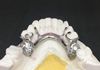 Chrome metal dentures