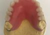 Upper denture