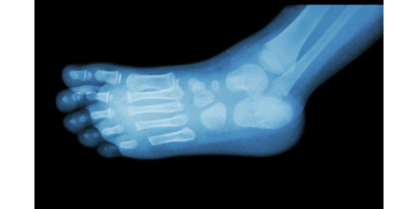 Xray of child's foot
