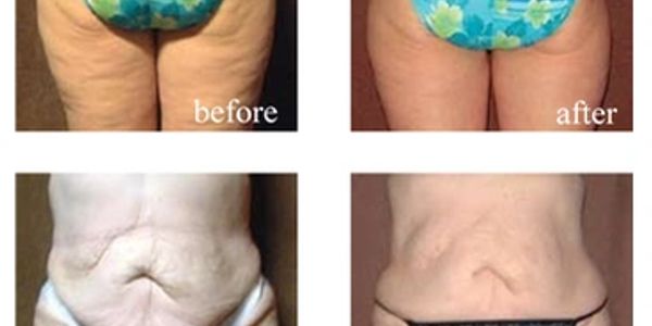 Best Cellulite Treatment - Oswego, Illinois