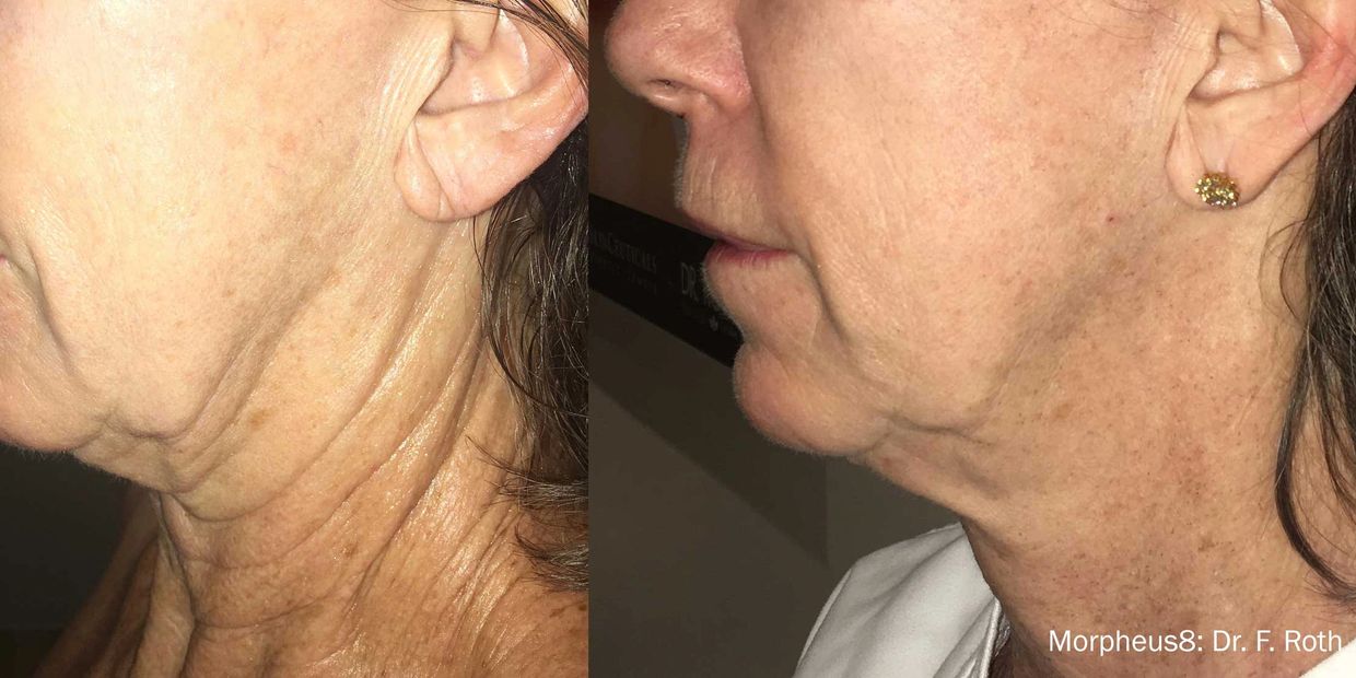 Morpheus 8 neck lift 