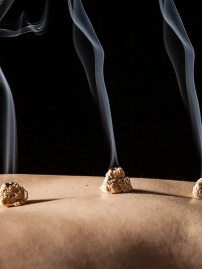 Moxibustion