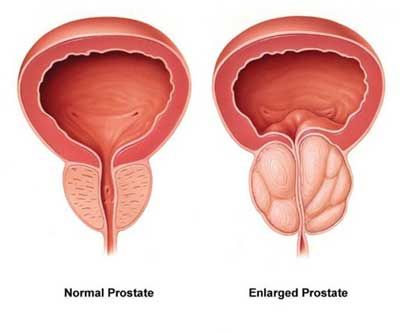 prostatitis acupuncture)