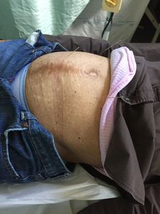 Fibroids and cysts treatment