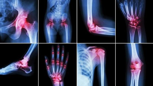 Acupuncture for arthritis pain