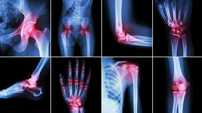 Acupuncture for arthritis