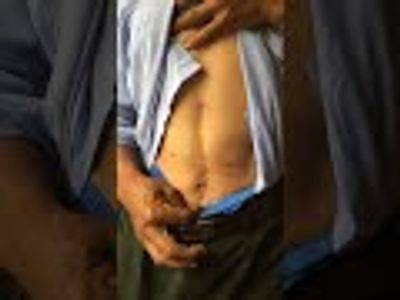 Stomach cancer survivor