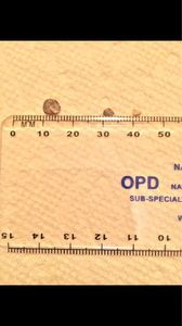 Kidney stone treatment