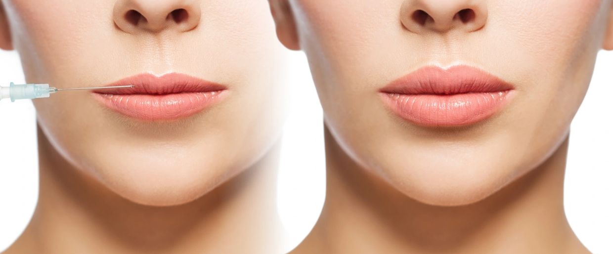aumento de labios acido hialuronico