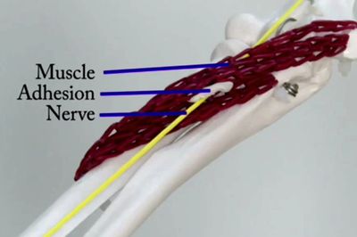 Peripheral Nerve Entrapment