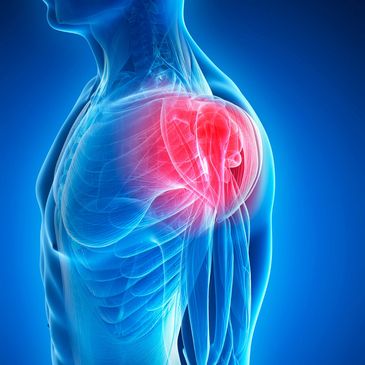Shoulder pain, rotator cuff irritation, and limited range of motion.