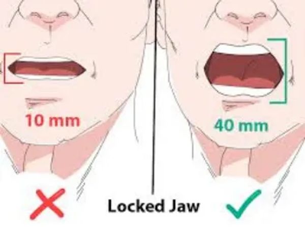 How to prevent jaw locking