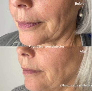 Sculptra before and after