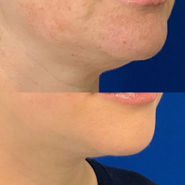 Kybella before and after 