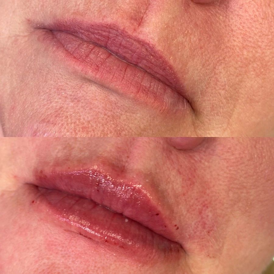 Before and after syringe of restyling kiss on a patient
