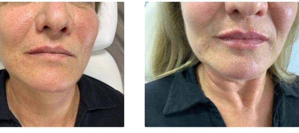A Woman Before and After Skin Treatment in Color Image