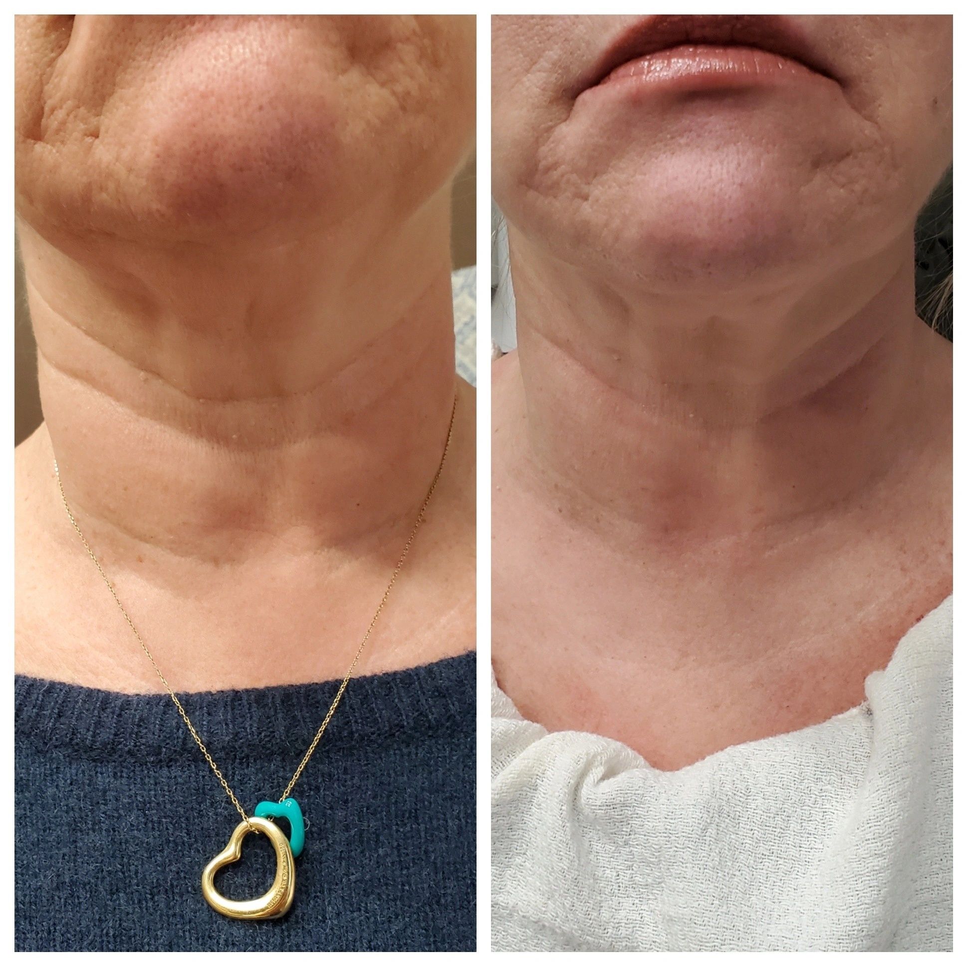 A Before and After Image of a Woman After Treatment