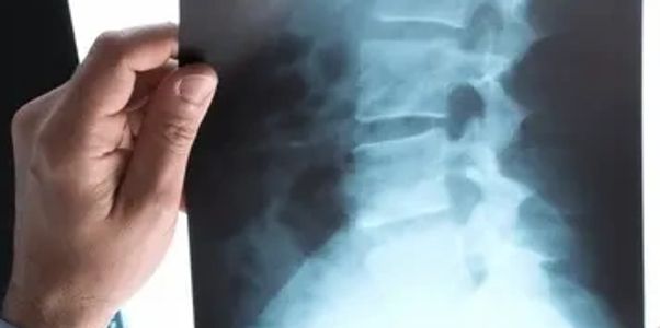 White male hands holding old Xray films up to light to see images of neck, low back