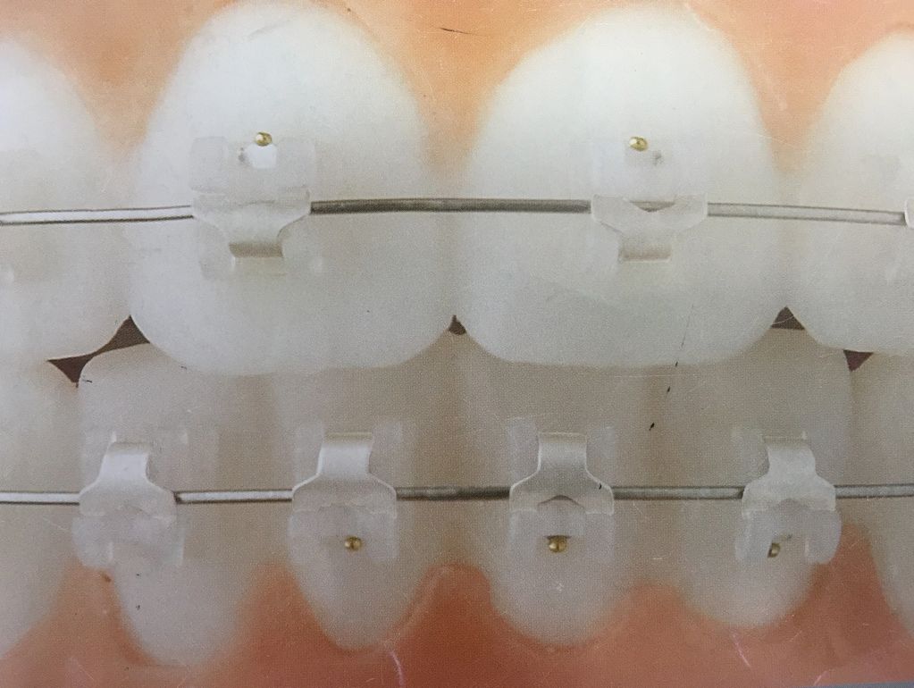 BRACKETS AUTOLIGADO ESTÉTICO GRAN EFICIENCIA CLÍNICA 
CERO PIGMENTACIÓN