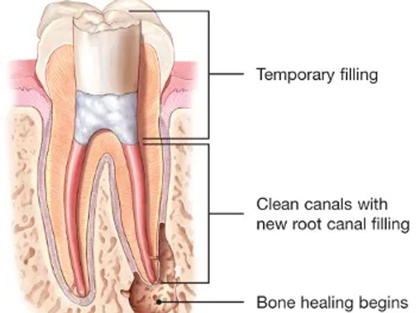 All You Need to Know About Temporary Tooth Fillings