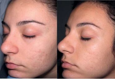 Microneedling