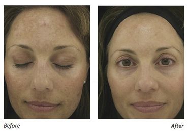 (2) Vipeel Precision Plus + (2) IPL Photofacials