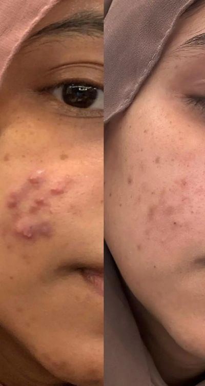 Facial hijama wet cupping results 