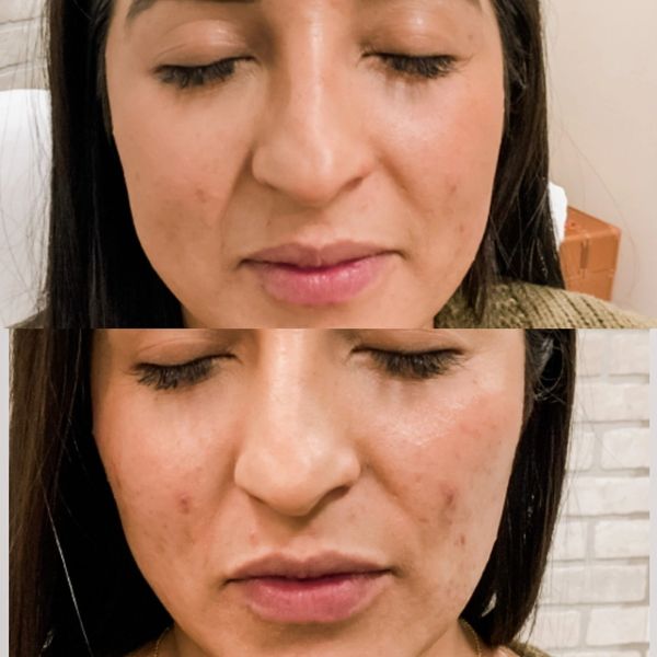 Cheek filler to define her mid face and decrease the nasolabial folds