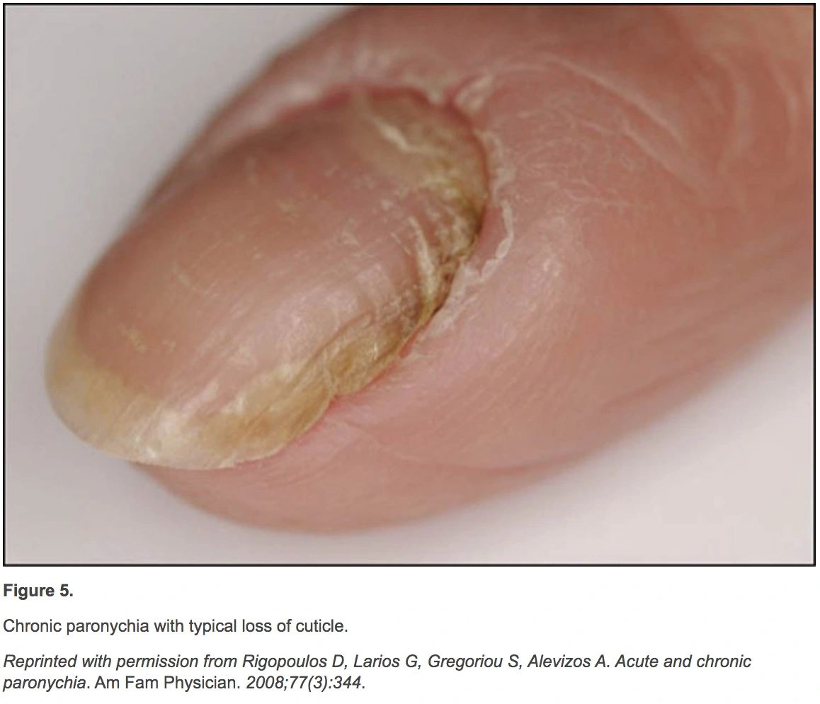 7 Nail Changes You Shouldn't Ignore 7 Nail Changes You Shouldn't Ignore
