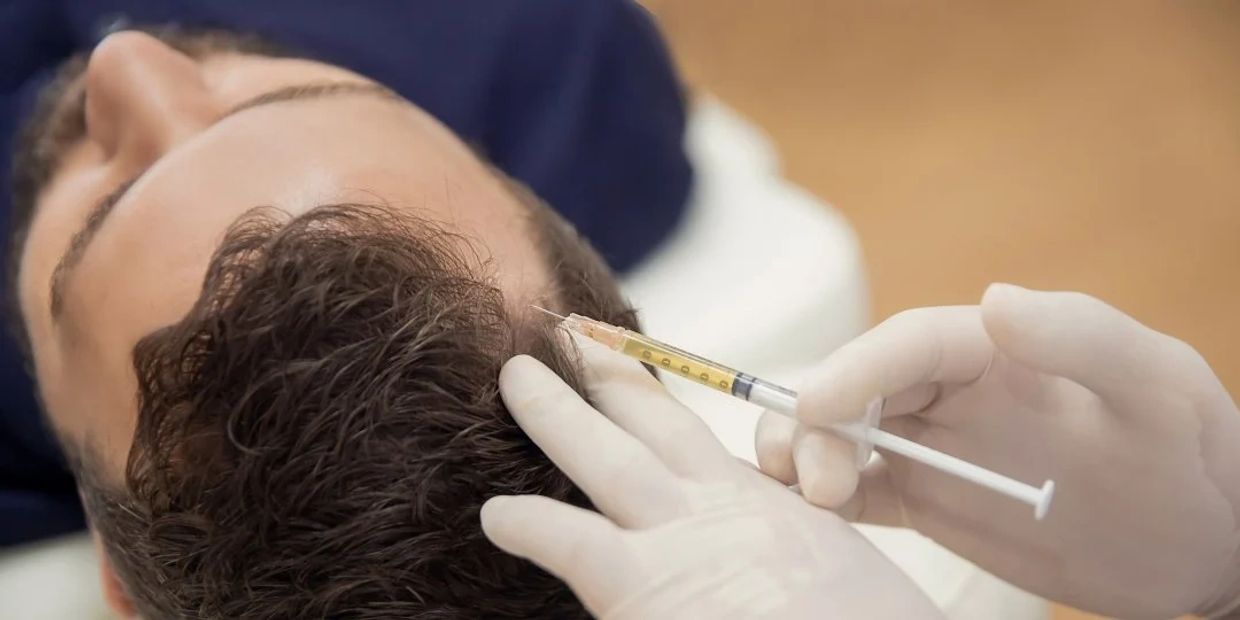 Hair restoration injections