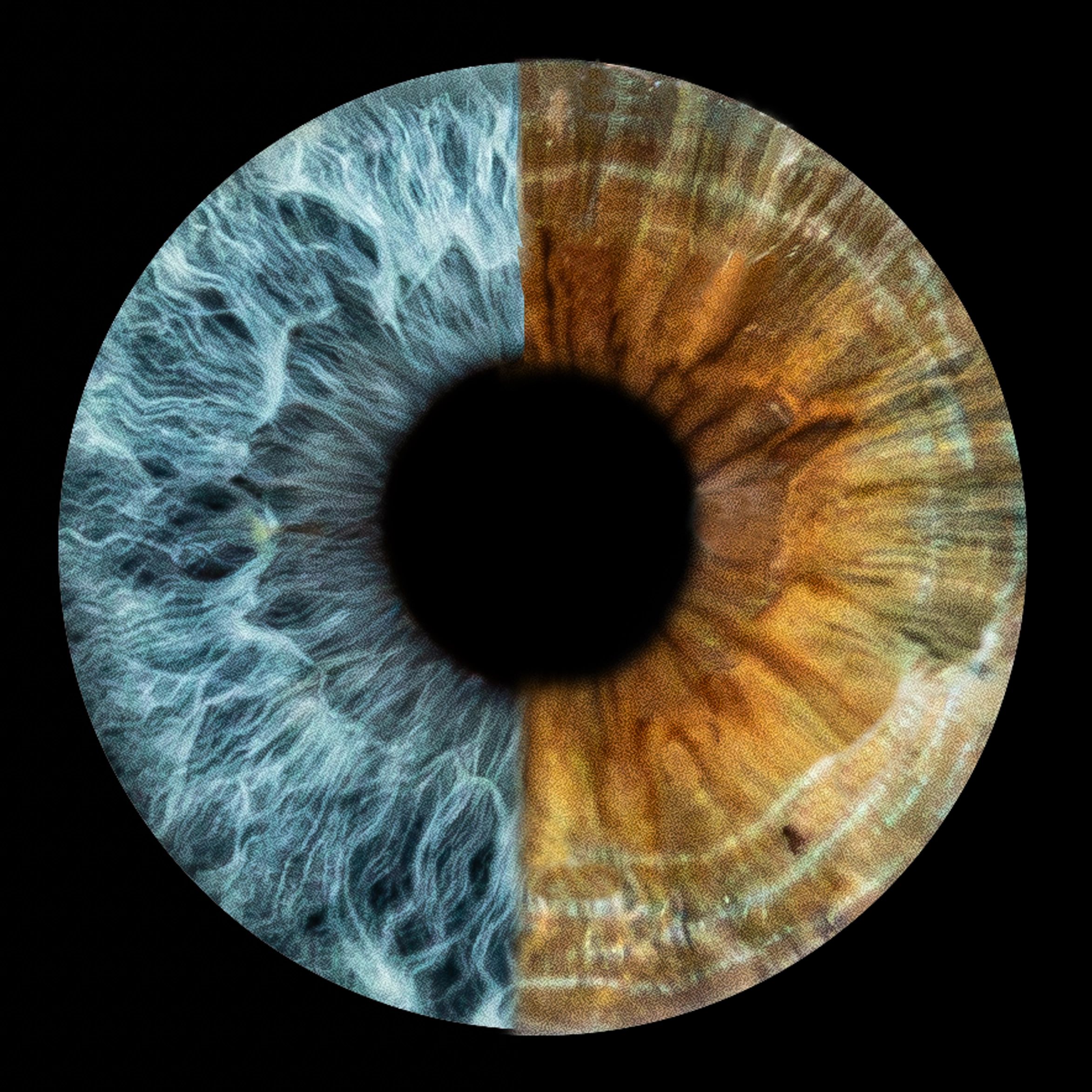 Close-up of a human iris with blue and brown halves.