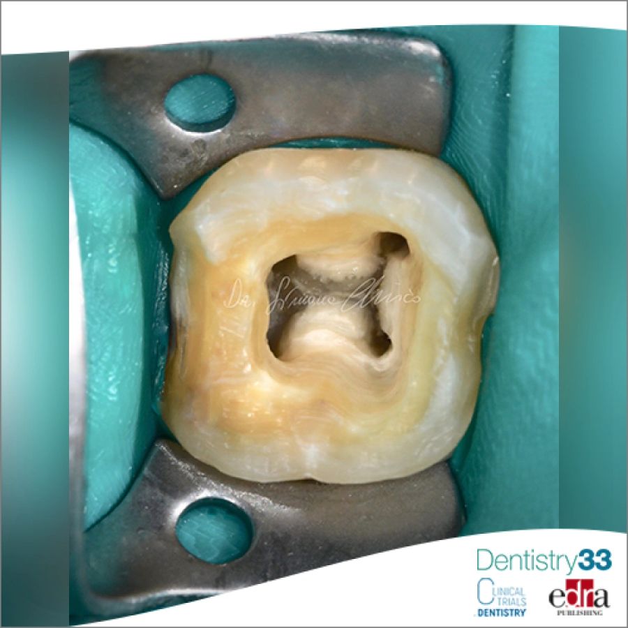 Endodontic access cavity prepared on a tooth model