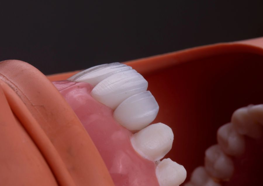 Close-up of veneer preparation during the hands-on workshop