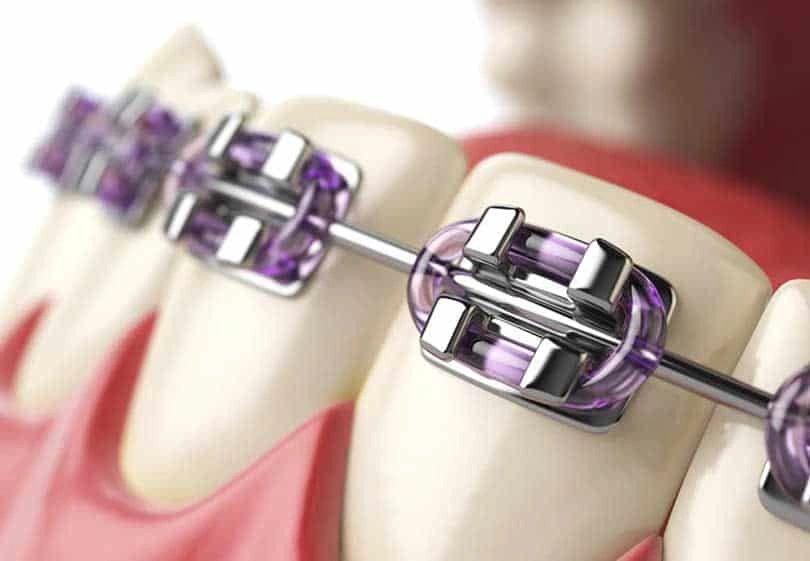 Orthodontic brackets and archwire on a dental model