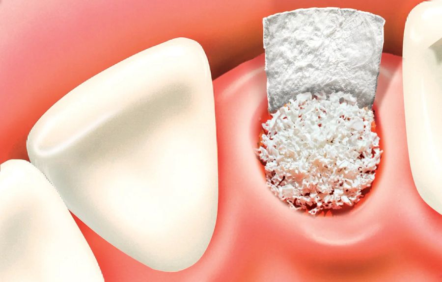 Ridge preservation procedure with biomaterials on a training model