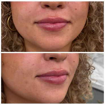 Before and after lip enhancement showing fuller, more defined lips.