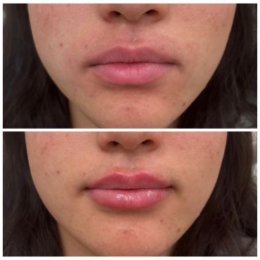 Before and after lip enhancement showing fuller, glossier lips.