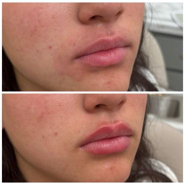 Before and after lip enhancement showing fuller lips.