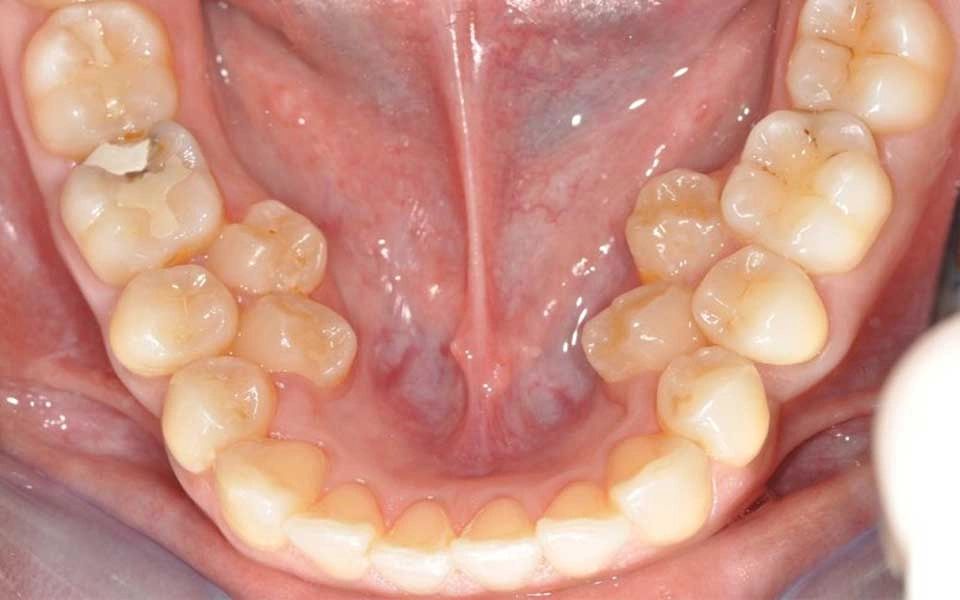 Que son dientes supernumarios?