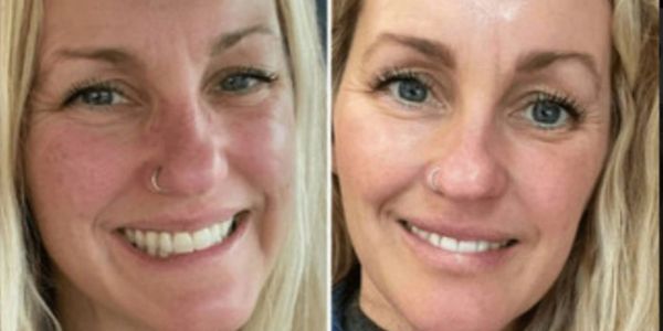 Frotox (Facial Therapy)