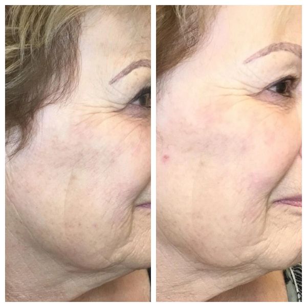 Photofacial Results