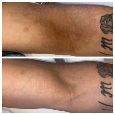 Reduction of hyperpigmentation with micro needling by SkinPen
