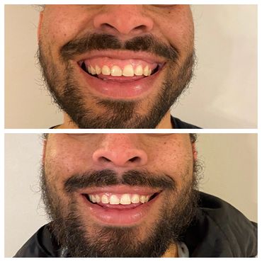 Botox results for gummy smile