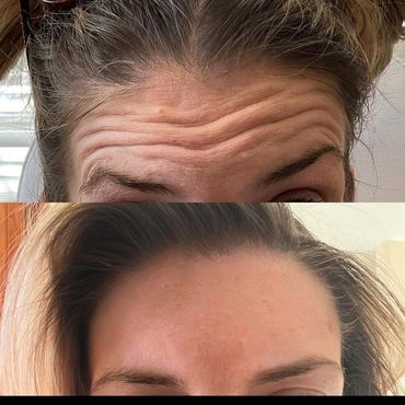 Botox results for forehead wrinkles