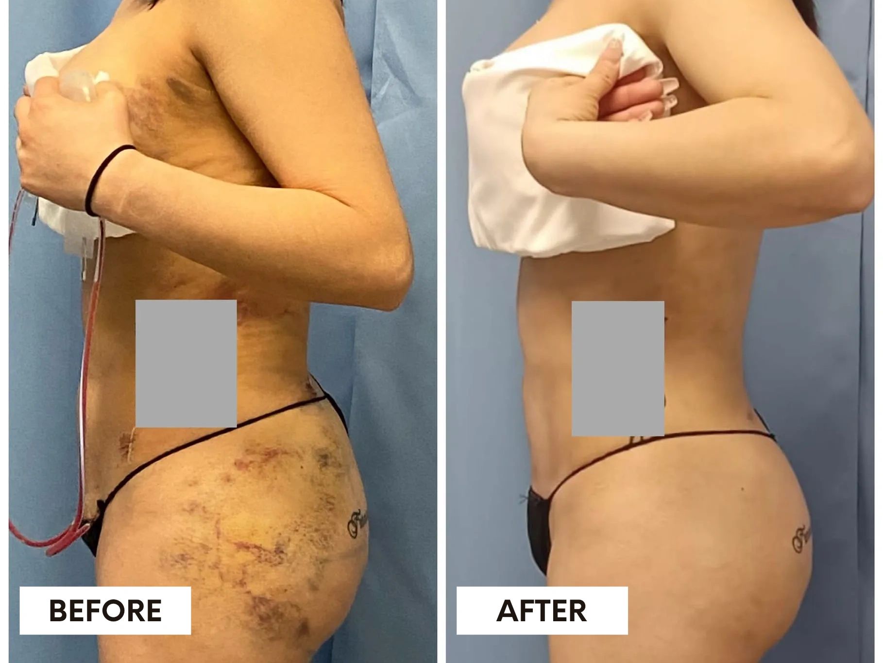 Before and after lymphatic drainage for post-op
